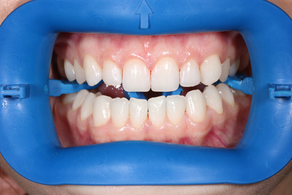 улыбка до отбеливания улыбка до отбеливания